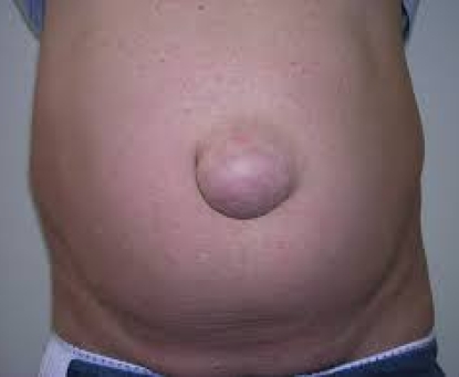 Tổng quan bệnh thoát vị rốn